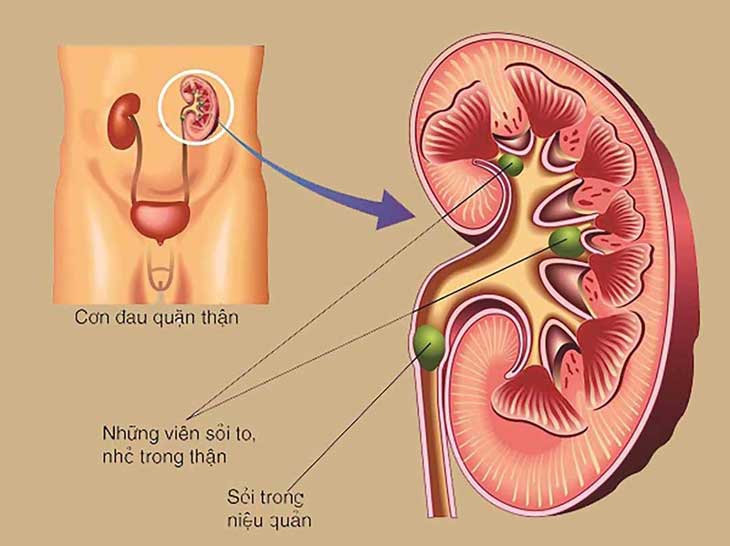 Sỏi tiết niệu: Cách nhận biết và phòng ngừa