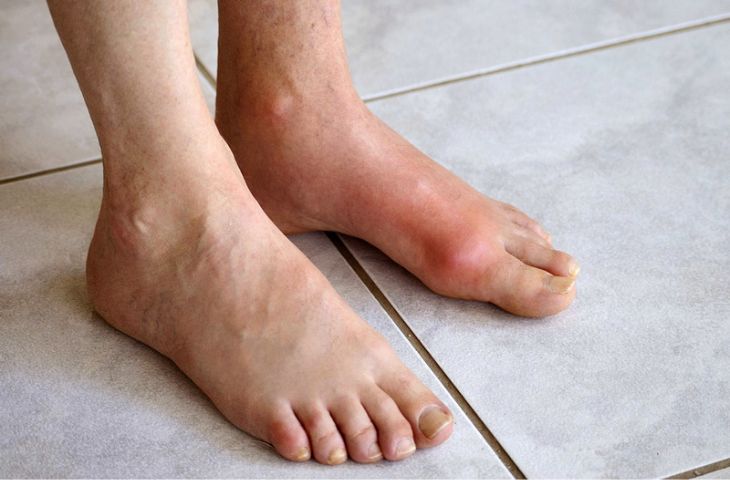 Bệnh gout: Triệu chứng của bệnh gout và phác đồ điều trị