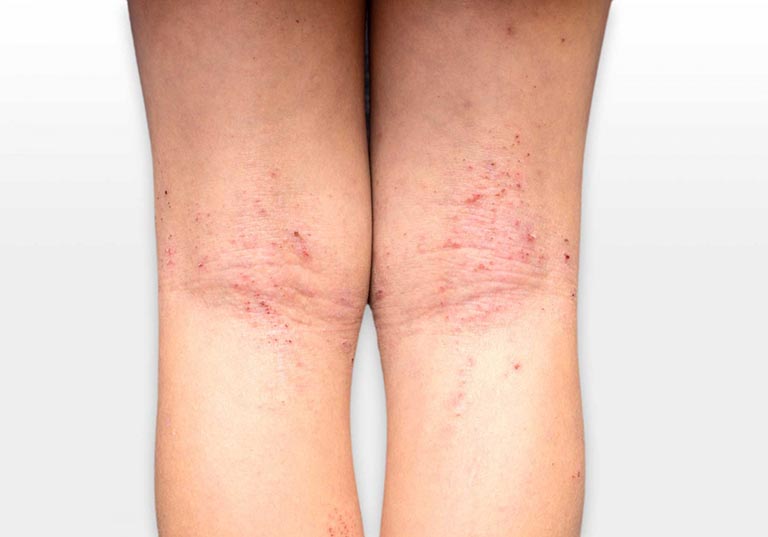 Nguyên nhân gây viêm da cơ địa: Góc nhìn từ Đông y và Tây y