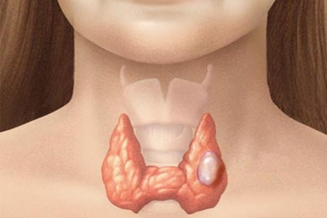 U tuyến giáp: U nang Tuyến Giáp có biểu hiện như thế nào? Và cách điều trị bằng thảo dược