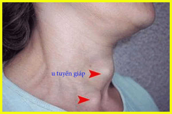 Ung thu tuyến giáp(u tuyến giáp ác tính) có chữa được không?