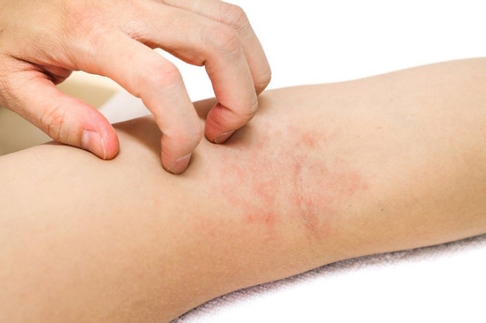 Viêm da cơ địa ở người lớn: Nguyên nhân, dấu hiệu và cách kiểm soát theo Đông y và Tây y