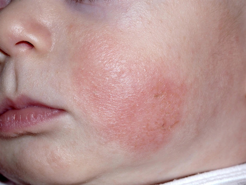 Viêm da cơ địa ở trẻ em: Nguyên nhân, dấu hiệu và cách chăm sóc
