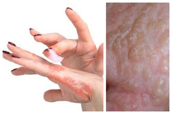 Dấu hiệu viêm da cơ địa: Nhận biết sớm theo Đông y và Tây y