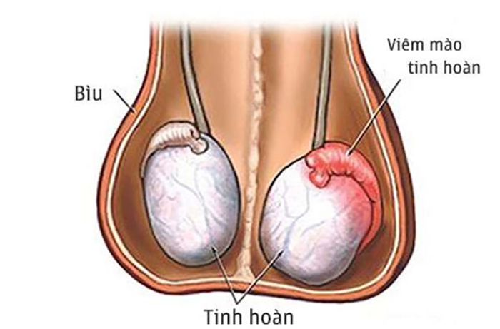 Lưu ý: 4 Dấu hiệu nhận biết bệnh Viêm tinh hoàn