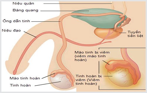 Triệu chứng viêm tinh hoàn và phác đồ điều trị