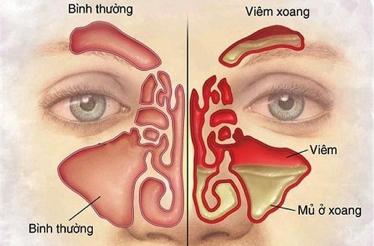 Các loại viêm xoang thường gặp