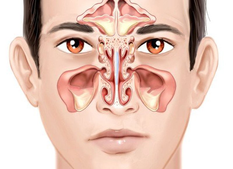 Các Triệu chứng Viêm Xoang và Cách điều trị Viêm Xoang