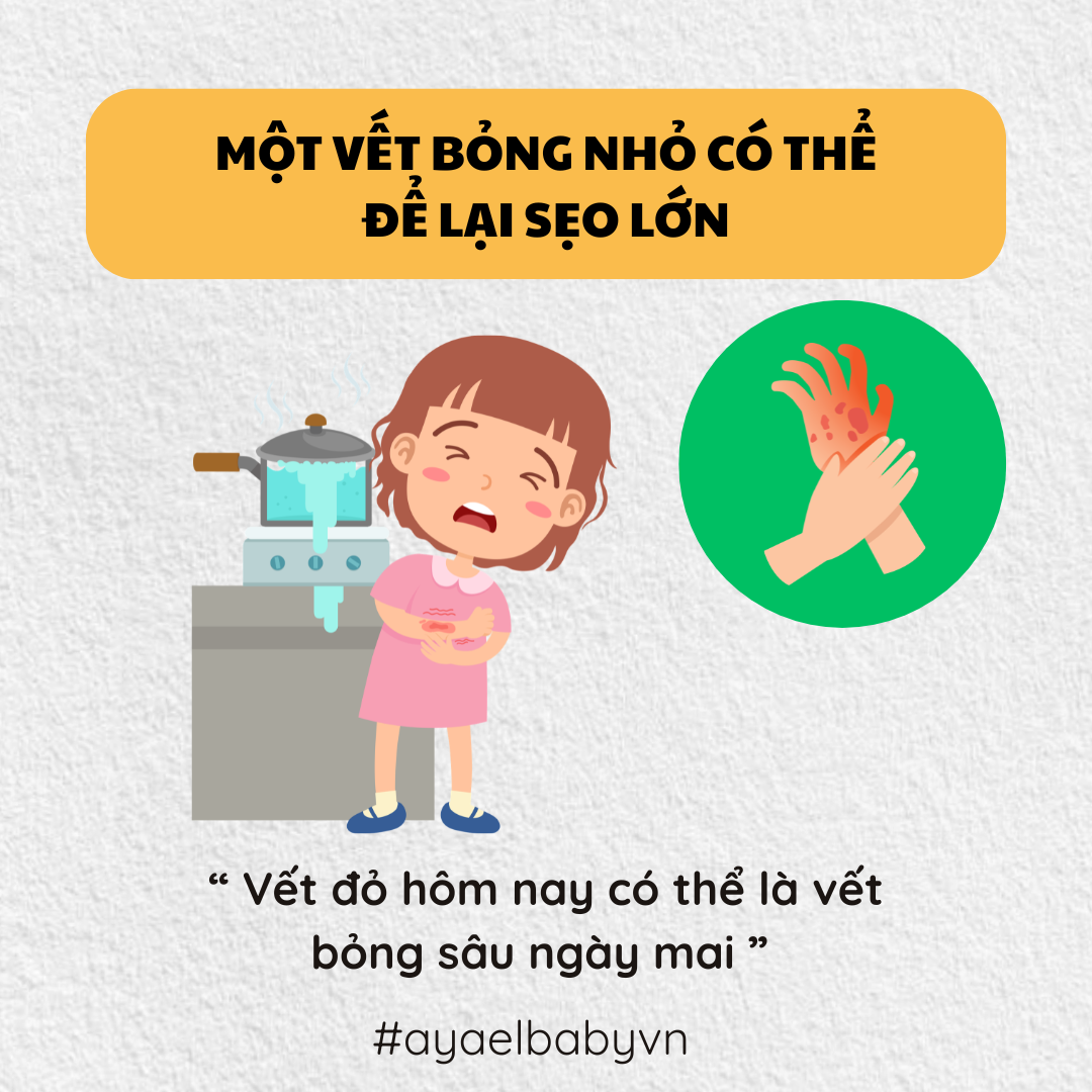 MỘT VẾT BỎNG NHỎ CÓ THỂ ĐỂ LẠI SẸO LỚN
