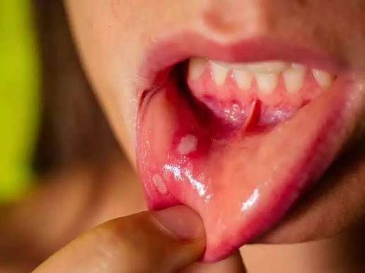 Bị Nhiệt Miệng Sau Quan Hệ Bằng Miệng Phải Làm Sao? Cách Chăm Sóc Và Phòng Ngừa
