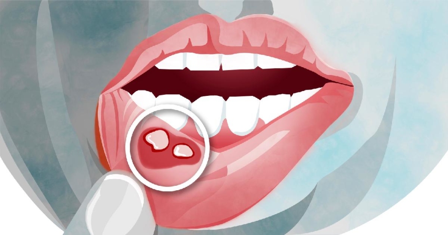 Bị Nhiệt Miệng Sau Quan Hệ Bằng Miệng Phải Làm Sao? Cách Chăm Sóc Và Phòng Ngừa