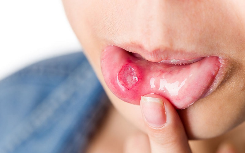 Bị Nhiệt Miệng Sau Quan Hệ Bằng Miệng Phải Làm Sao? Cách Chăm Sóc Và Phòng Ngừa