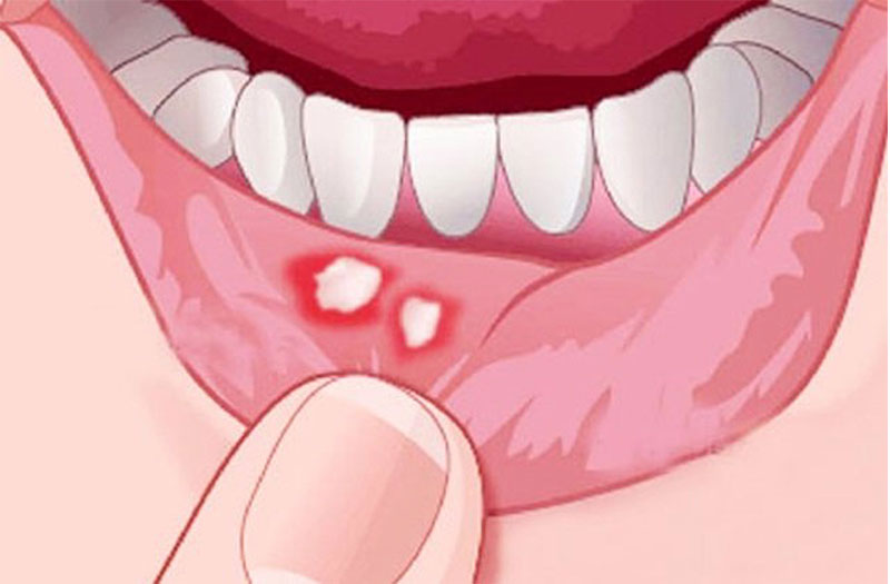 Bị Nhiệt Miệng Sau Quan Hệ Bằng Miệng Phải Làm Sao? Cách Chăm Sóc Và Phòng Ngừa