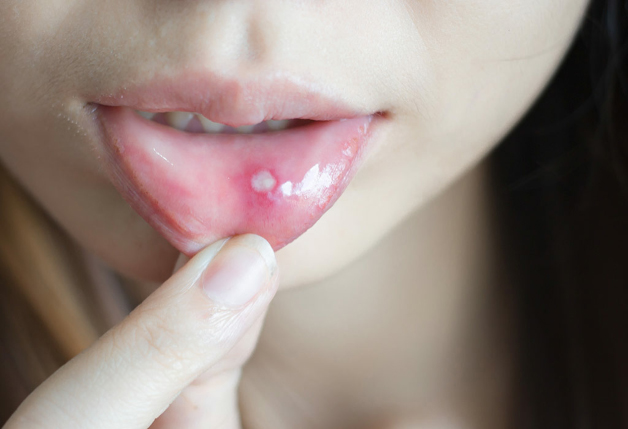 Bị Nhiệt Miệng Sau Quan Hệ Bằng Miệng Phải Làm Sao? Cách Chăm Sóc Và Phòng Ngừa