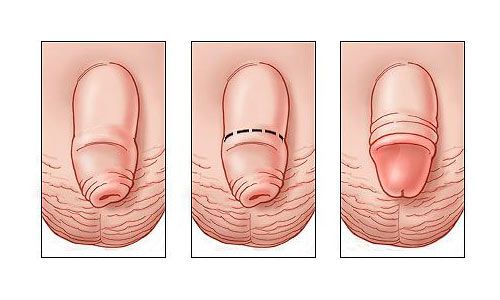 Rủi Ro Sau Cắt Bao Quy Đầu Và Cách Chăm Sóc Đúng Để Hồi Phục Nhanh