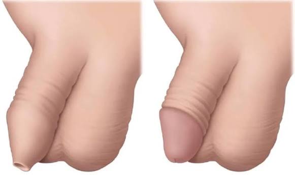 Rủi Ro Sau Cắt Bao Quy Đầu Và Cách Chăm Sóc Đúng Để Hồi Phục Nhanh