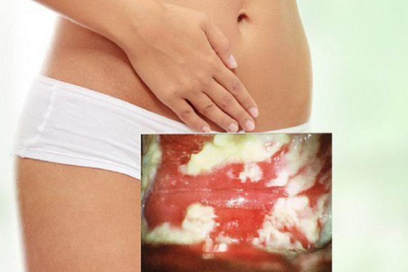Chưa Quan Hệ Có Bị Nấm Không? Sự Thật Về Nấm Âm Đạo Ở Phụ Nữ Trinh