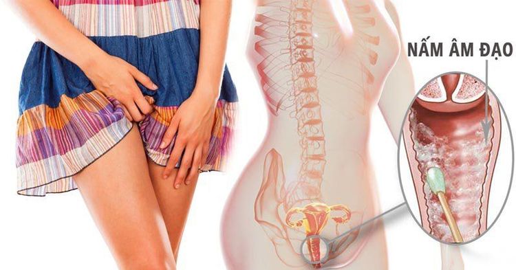 Chưa Quan Hệ Có Bị Nấm Không? Sự Thật Về Nấm Âm Đạo Ở Phụ Nữ Trinh