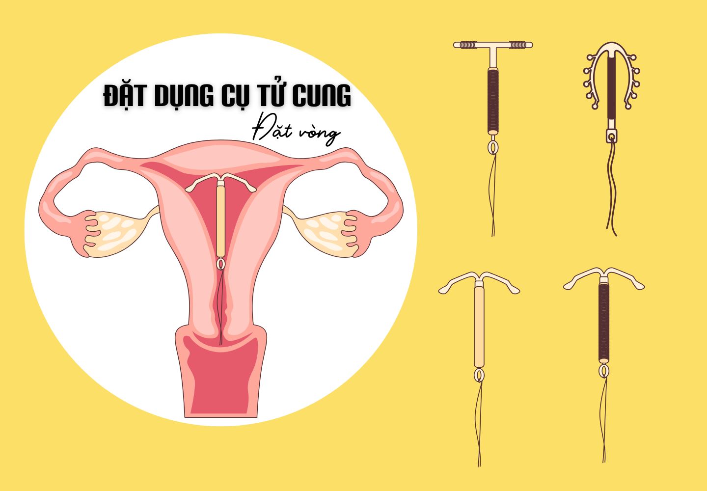 Đặt Vòng Tránh Thai Có An Toàn Không? Chi Phí, Địa Điểm Và Những Lưu Ý Quan Trọng
