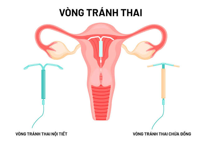 Đặt Vòng Tránh Thai Có An Toàn Không? Chi Phí, Địa Điểm Và Những Lưu Ý Quan Trọng