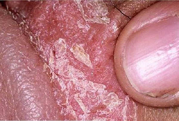 Dương Vật Bị Khô: Nguyên Nhân, Nguy Hiểm Và Cách Khắc Phục Hiệu Quả