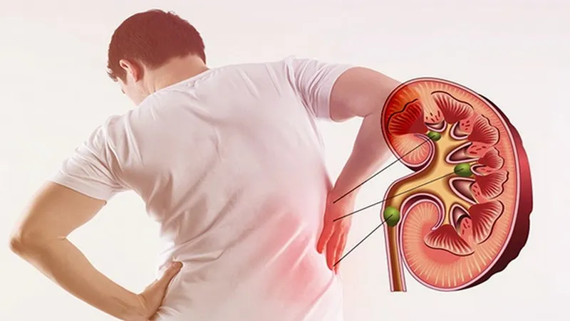 Lời Khuyên Quan Hệ An Toàn Cho Người Bị Sỏi Thận