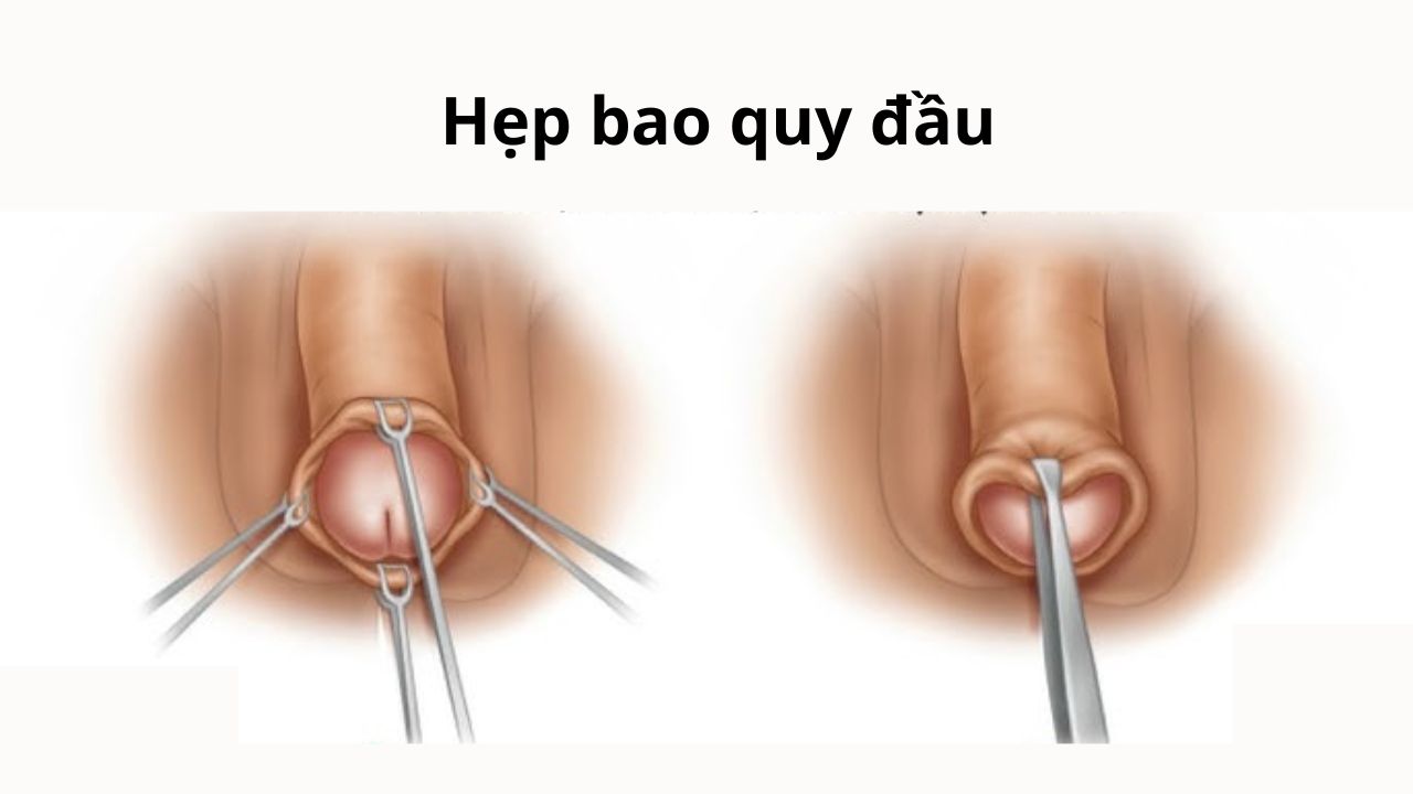 Hẹp Bao Quy Đầu Có Sao Không? Hướng Dẫn Khám Và Chữa