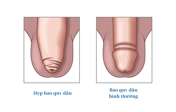 Hẹp Bao Quy Đầu Có Sao Không? Hướng Dẫn Khám Và Chữa