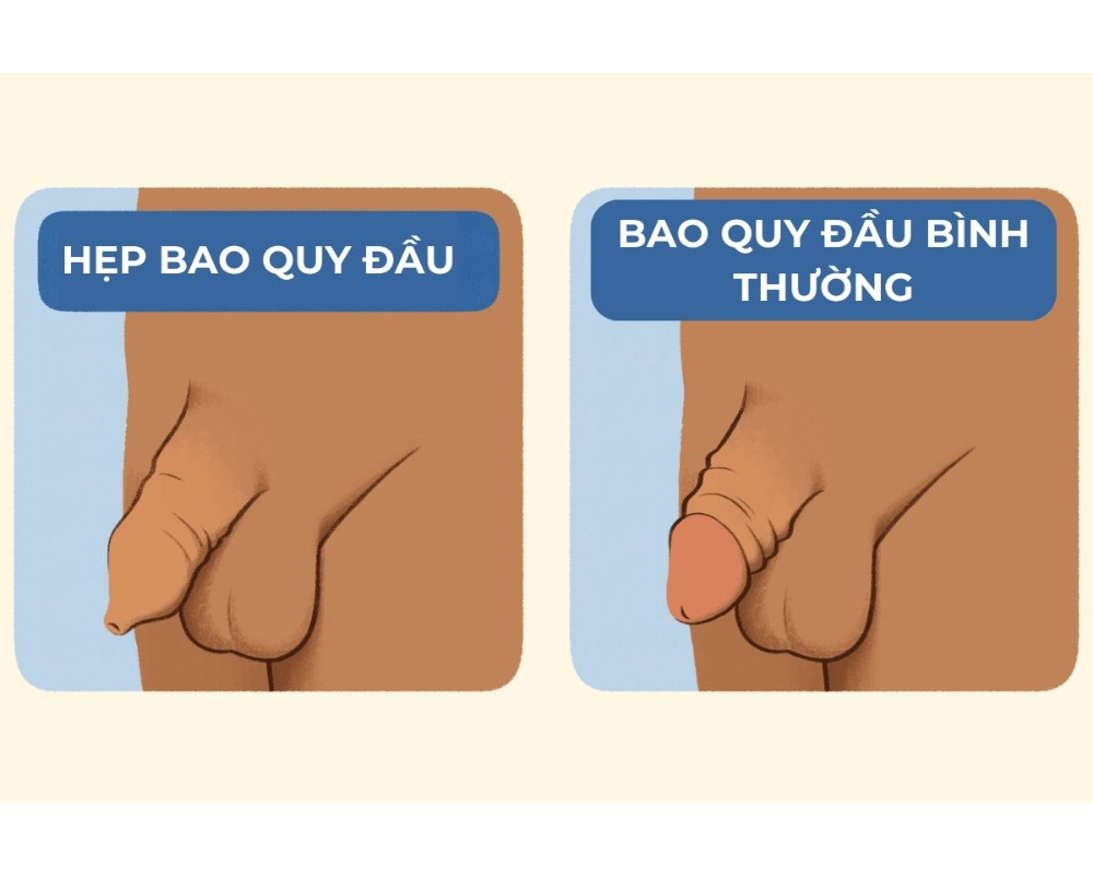 Hẹp Bao Quy Đầu Có Sao Không? Hướng Dẫn Khám Và Chữa