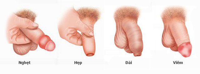 Hẹp Bao Quy Đầu Có Sao Không? Hướng Dẫn Khám Và Chữa
