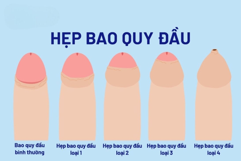 Hẹp Bao Quy Đầu Có Sao Không? Hướng Dẫn Khám Và Chữa