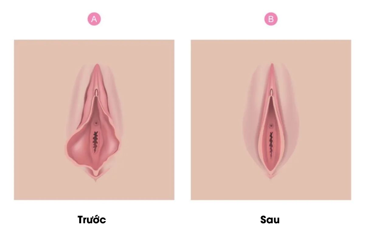 Môi Bé Bị Dài 1 Bên: Có Sao Không, Khi Nào Cần Khắc Phục?