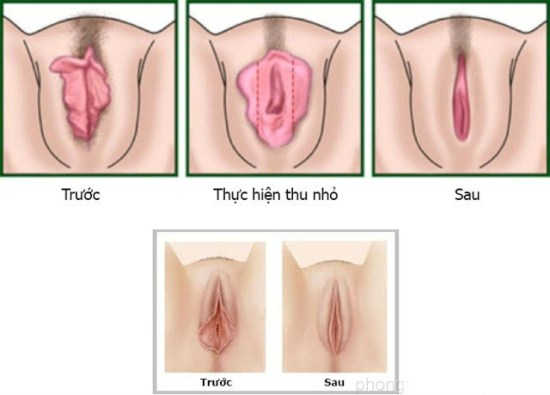 Môi Lớn Chảy Xệ Có Sao Không? Cách Khắc Phục An Toàn
