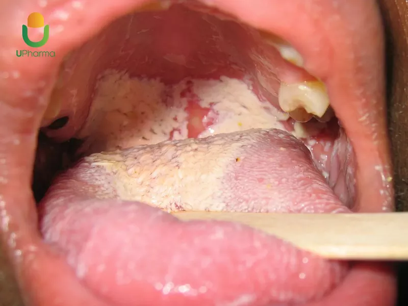 Quan Hệ Bằng Miệng Có Bị Nhiễm Nấm Candida Không? Cách Thực Hiện An Toàn