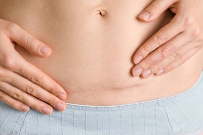 Sinh Mổ Bao Lâu Thì Quan Hệ Bằng Miệng Được? Lưu Ý An Toàn Hậu Sản