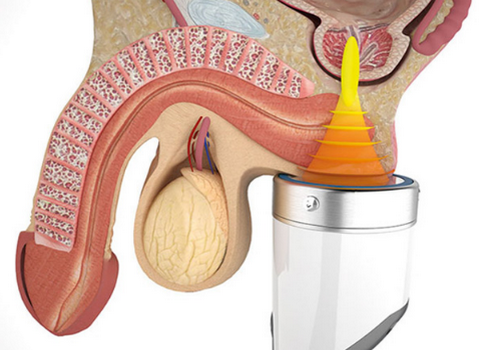 Sóng Xung Kích Điều Trị Rối Loạn Cương Dương Có Hiệu Quả Không?