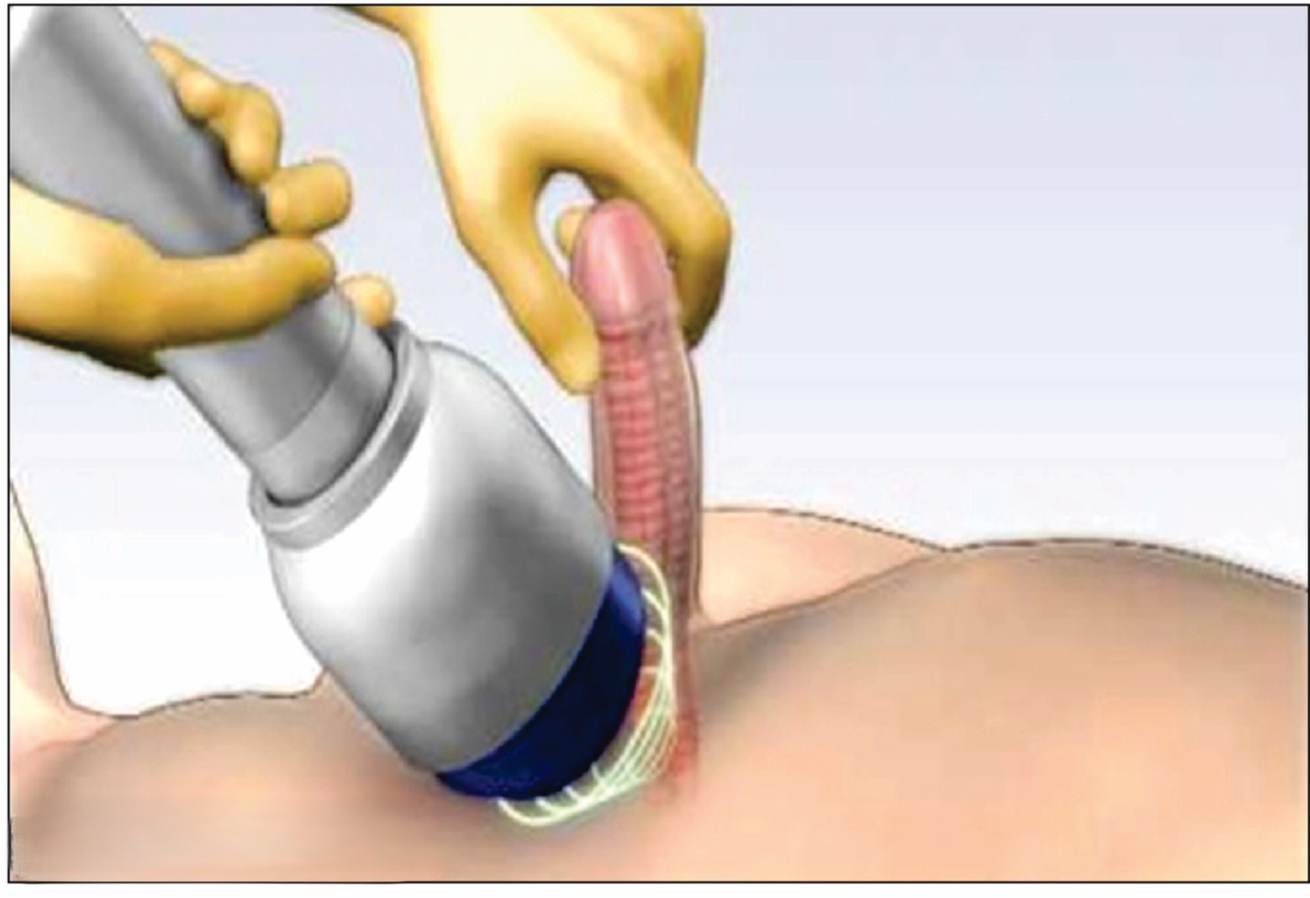 Sóng Xung Kích Điều Trị Rối Loạn Cương Dương Có Hiệu Quả Không?