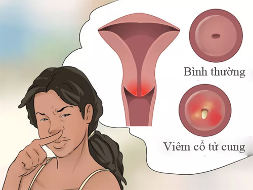 Vùng Kín Có Mùi Hôi Là Bệnh Gì? 5 Nguyên Nhân Thường Gặp Và Lưu Ý
