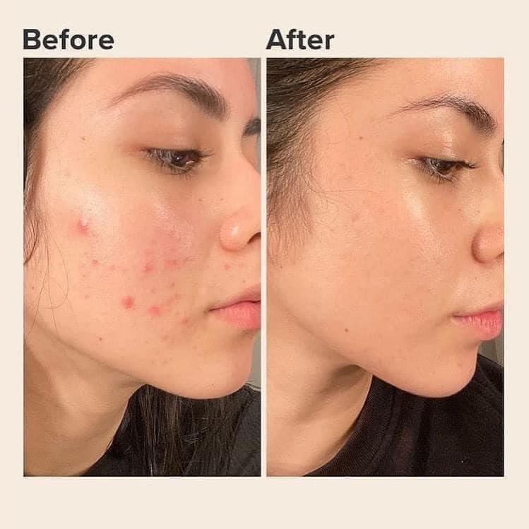 Kem dưỡng da trị mụn Kracie Hadabisei Acne Care Facial Cream Nhật 50gr
