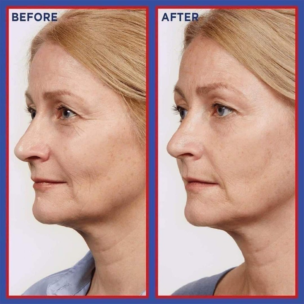 Serum dưỡng da chống lão hóa của Loreal Revitalift Laser Retinol Pháp