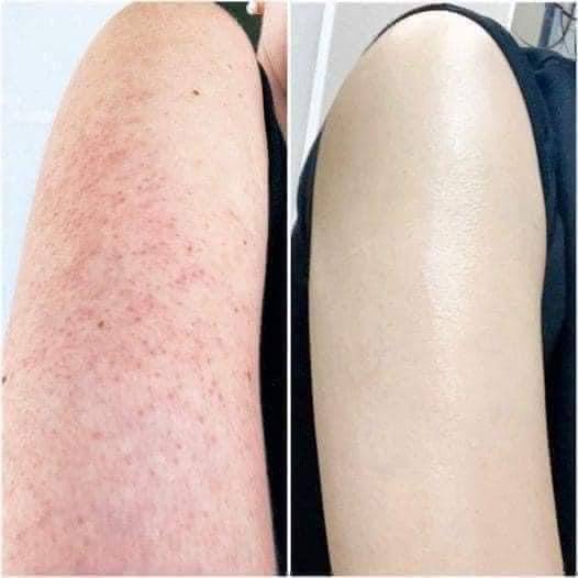 Kem trị viêm lỗ chân lông Rohto Nhật Bản tuýp 35gr