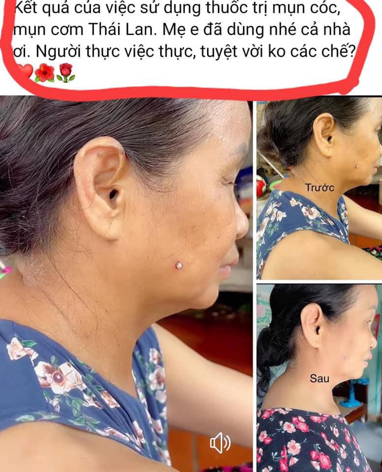 Thuốc đặc trị mụn cóc Thái Lan