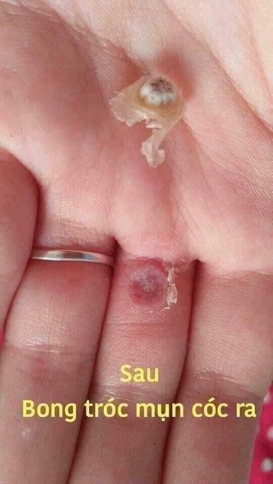 Thuốc đặc trị mụn cóc Thái Lan