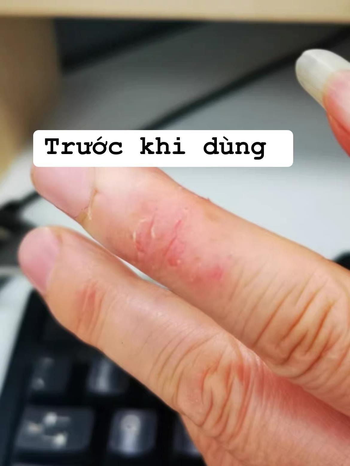 Thuốc bôi Viêm da, á sừng, vẩy nến, lang ben đông y Trung Quốc tuyps 15gr
