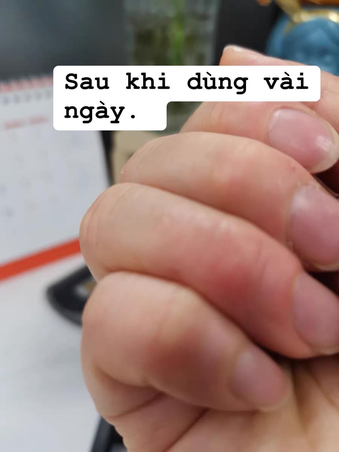 Thuốc bôi Viêm da, á sừng, vẩy nến, lang ben đông y Trung Quốc tuyps 15gr