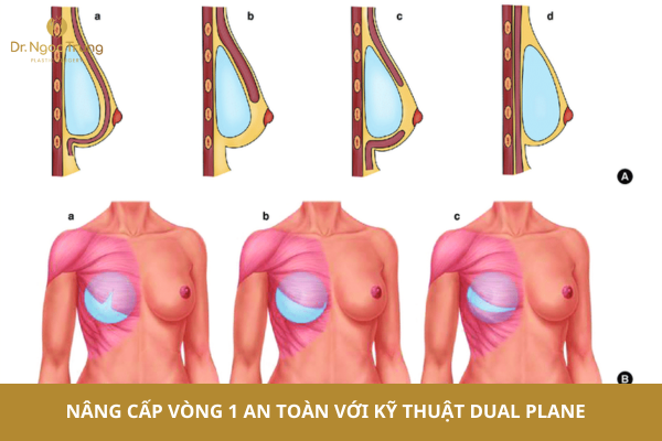 Hiểu đúng và đủ về kỹ thuật nâng cấp vòng 1 Dual Plane