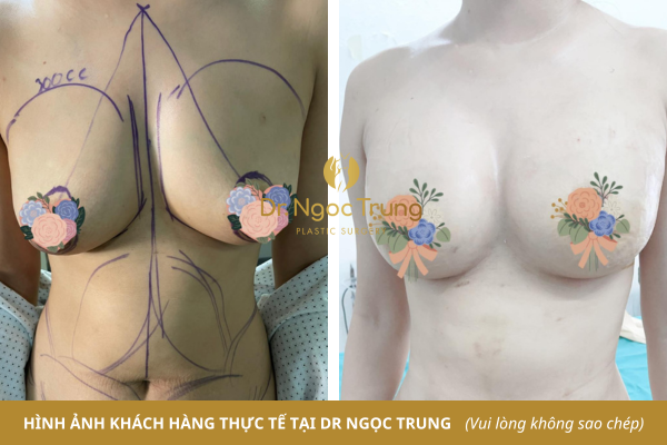 Hút mỡ, tạo hình thành bụng