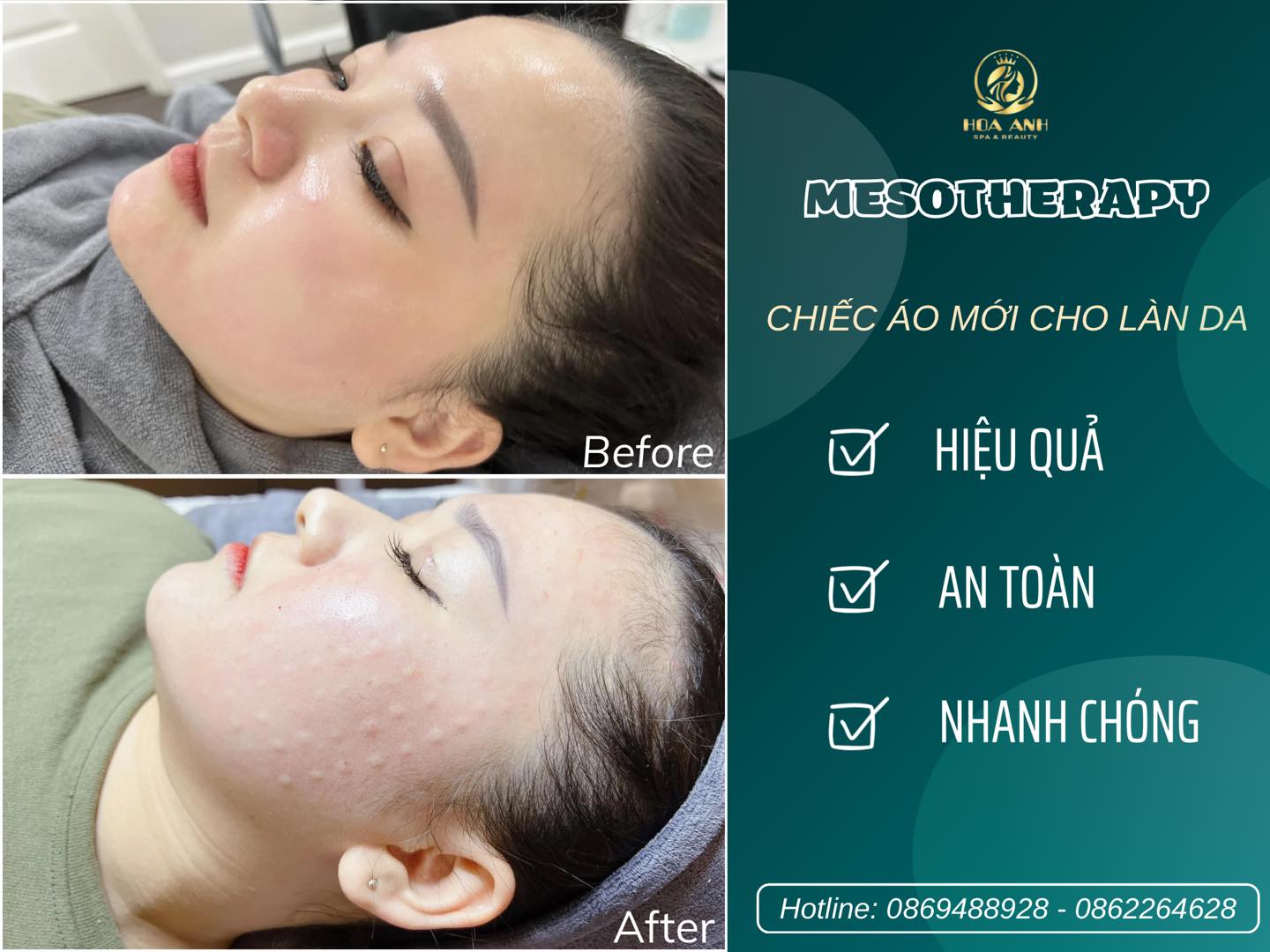 MESOTHERAPY CÓ THỰC SỰ GIÚP DA CĂNG BÓNG - MESO THERAPY GIỮ ĐƯỢC BAO LÂU