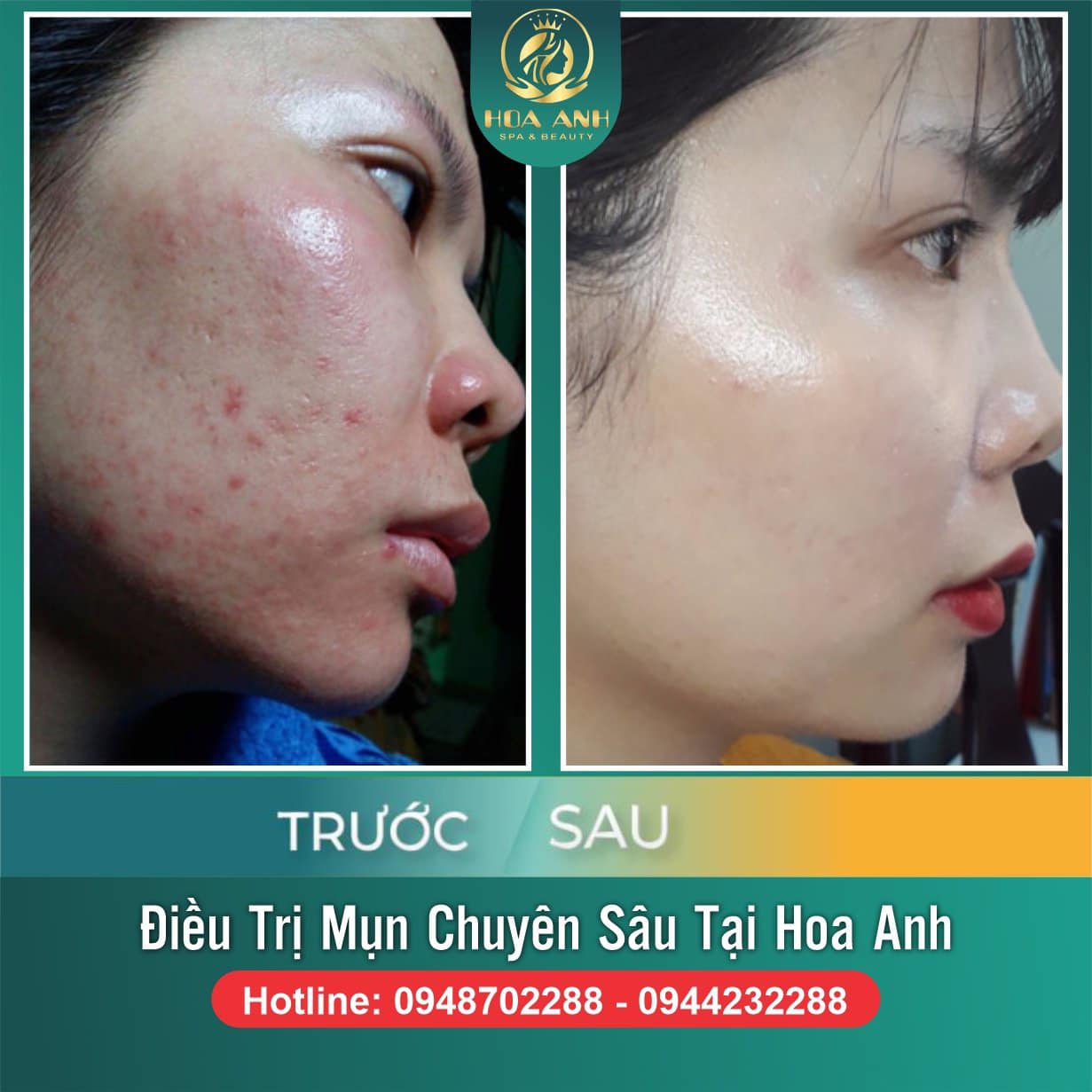 CÓ NÊN NẶN MỤN KHÔNG ? ĐIỀU TRỊ MỤN CHUẨN Y KHOA TẠI VIỆN THẨM MỸ HOA ANH