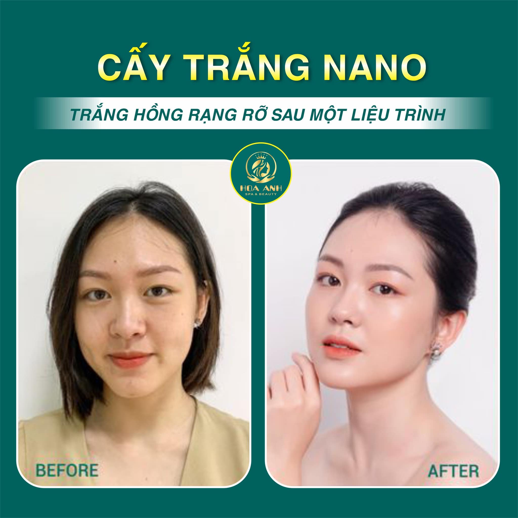 CẤY TRẮNG DA MẶT LÀ GÌ - CÁC PHƯƠNG PHÁP LÀM TRẮNG DA MẶT AN TOÀN VÀ HIỆU QUẢ